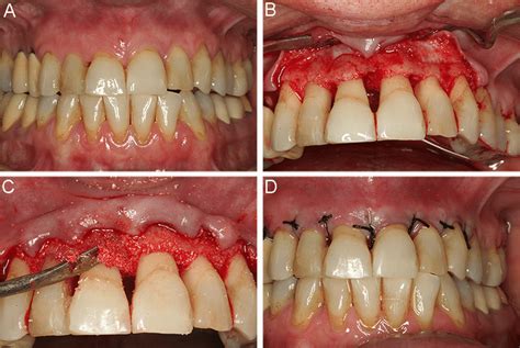 A) Clinical view after basic periodontal therapy; B) Widman surgical... | Download Scientific ...