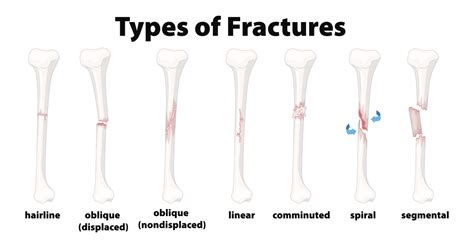 Understanding the Different Types of Bone Fractures - Comprehensive Orthopaedics