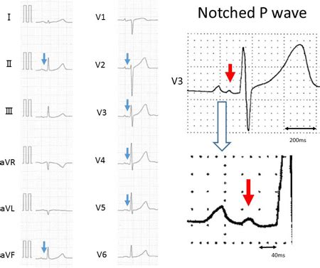 Abstract 18211: Notched P Wave Component is a New Electrocardiographic ...