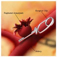 Microsurgical Clipping for Brain Aneurysms | Treatment Techniques | Johns Hopkins ...