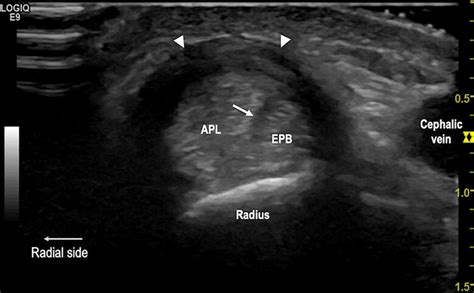 “Daddy wrist”: A high‐resolution ultrasound diagnosis of de Quervain ...