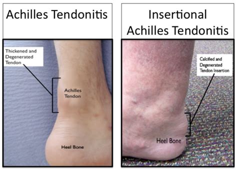 Chronic Achilles Tendon Problems | Murdoch Orthopaedic Clinic