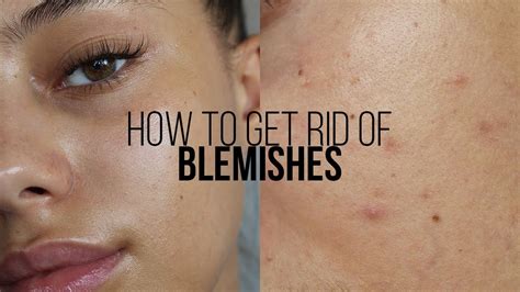 What is blemished skin? – Fiona Lawson