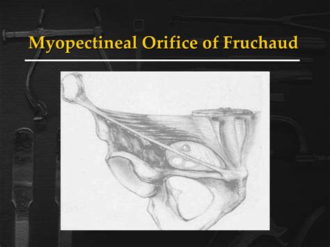 PPT - Inguinal Hernias PowerPoint Presentation - ID:218475