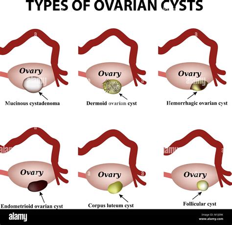 Ovarian Cancer Anatomy