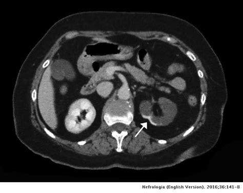 Acute renal infarction: Clinical characteristics and prognostic factors ...