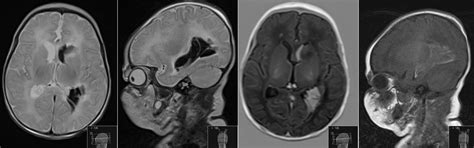 Radiology MRI: Neonatal Intraventricular Hemorrhage