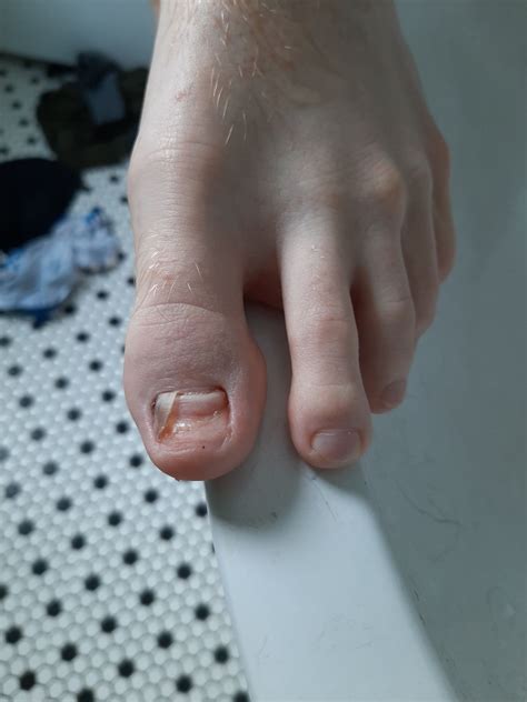 My toenail got ripped off. Will take 1-2 YEARS to regrow : r/Wellthatsucks