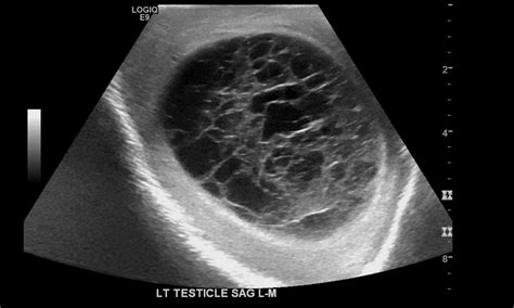 Annals of B Pod - Epididymitis to Pyocele — Taming the SRU