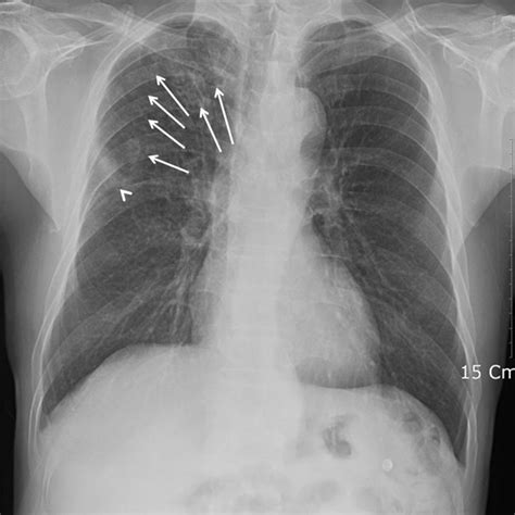 Chest computed tomography shows clustered centrilobular nodules (arrows... | Download Scientific ...