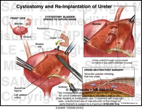 Cystostomy and Re-Implantation of Ureter Medical Exhibit