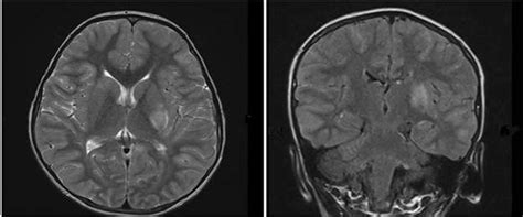 MRI with contrast showed abnormal T2 and FLAIR hyper intense signals in... | Download Scientific ...