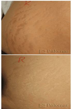 Stretch Marks (Striae) in Brooklyn, NY | Dr. Ghatan Dermatology, Cosmetic & Laser Surgery