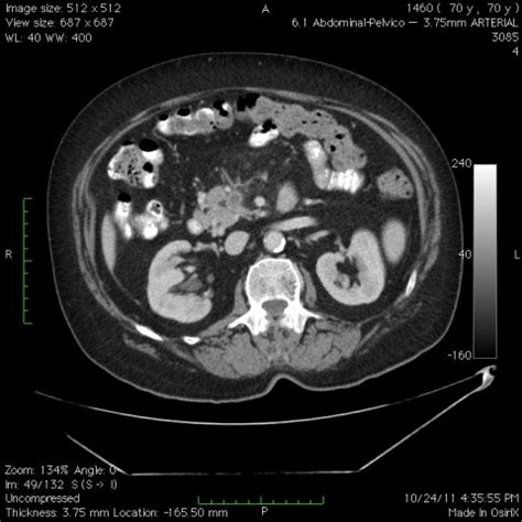 Persistent fever and lumbar pain | Eurorad