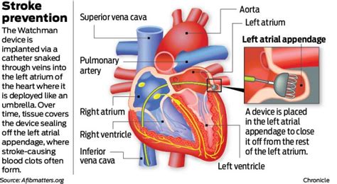 MAPMG Cardiologists Perform New Watchman Procedure, Reduce Risk of ...