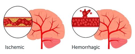 Terapi Trombolisi - Indonesian Stroke Society