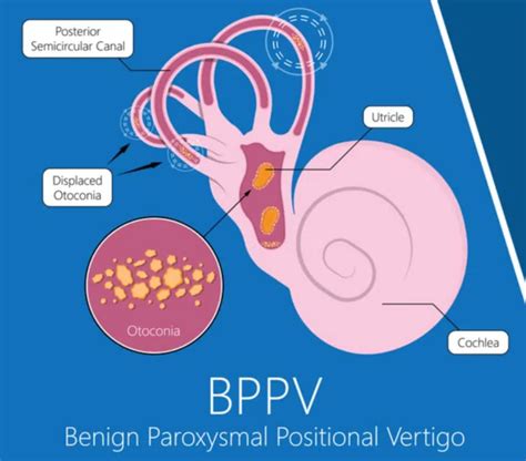 Benign Paroxysmal Positional Vertigo: A Case Study - Physiopedia