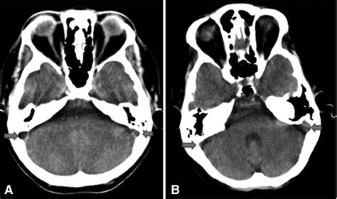 Differentiation of Transverse Sinus Thrombosis From Congenitally Atretic Cerebral Transverse ...