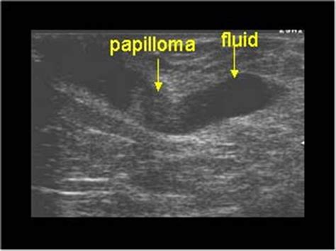 Breast and Axilla | 5.1 Benign lesions : Case 5.1.10 Ductal lesions ...