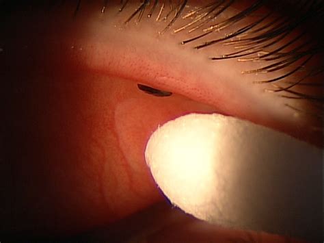 T15.11XA-12XS Foreign Body In Conjunctival Sac - Decision-Maker PLUS