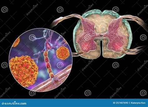 Polio Viruses Affecting Motor Neurons Stock Illustration - Illustration of disease, picornavirus ...