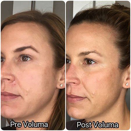 Juvéderm Fillers – Adore Aesthetix