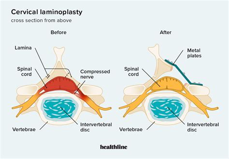 Cervical Laminoplasty