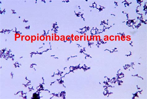 Propionibacterium acnes, infection, symptoms & treatment