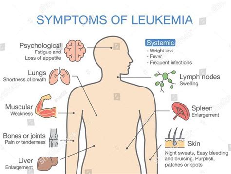 Petechiae Leukemia