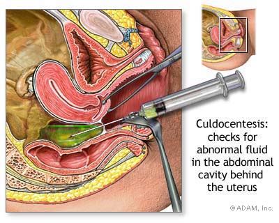 The New York Times > Health > Image > Culdocentesis