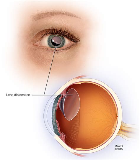 Marfan Syndrome - Causes, Symptoms, Prognosis, Diagnosis, Treatment