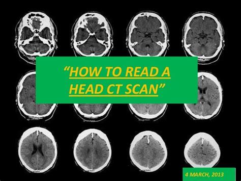 Ct Brain Anatomy - Anatomy Reading Source