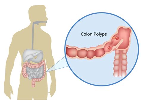 Intestinal Polyps Symptoms