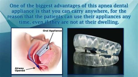 Dental Sleep Apnea Appliance