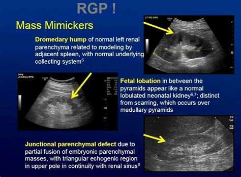 Renal ultrasound made easy step by step guide – Artofit