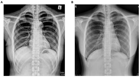 Iatrogenic Pneumothorax during Acupuncture: Case Report