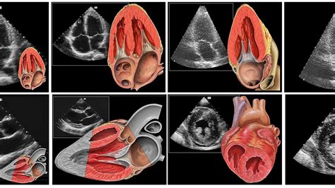 TTE: Transthoracic Echocardiogram - SONOSIF - by SIFSOF, California