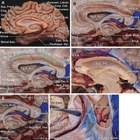 Corpus Callosotomy | The Neurosurgical Atlas