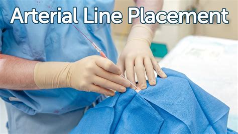 Arterial Line Placement - YouTube