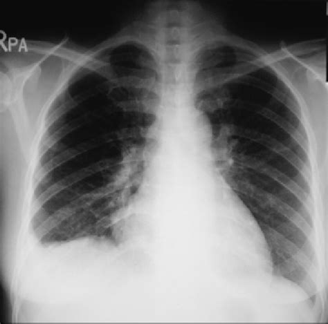 Chest X-ray. Chest x-ray shows mild cardiomegaly. | Download Scientific ...