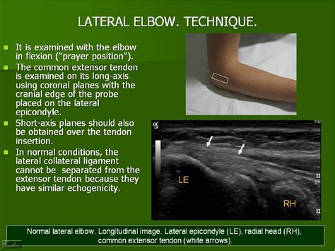 Figure 5 from Ultrasound of the elbow, what the radiologist should know ...