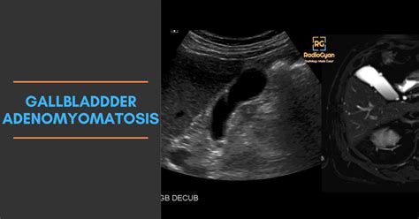 Diseased Gallbladder Ultrasound