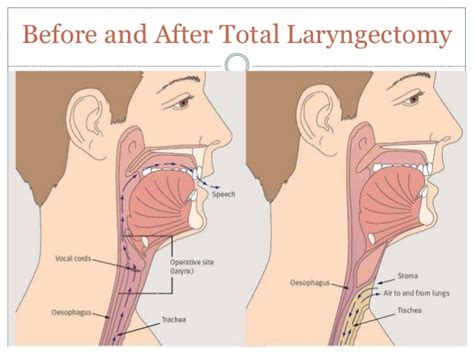 The laryngectomy patient