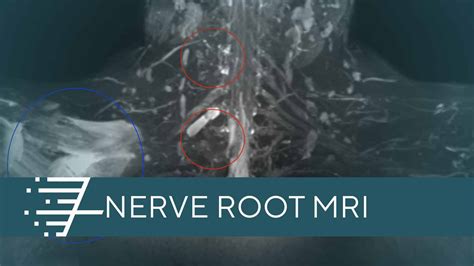 Nerve Root MRI » ARISTRA