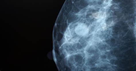 Breast Cancer: What We Know Today | The University of Vermont Health Network