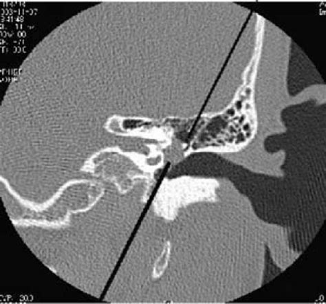 CT scan showing cholesteatoma | Download Scientific Diagram