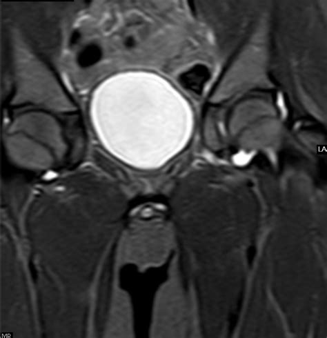 Transient Synovitis-Plain Film & MRI - Sumer's Radiology Blog