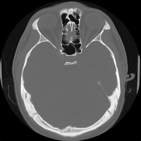 Normal temporal bone CT with annotated images (Radiopaedia 84293-99584 ...