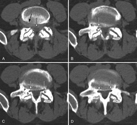 Lateral Recess Stenosis | Radiology Key