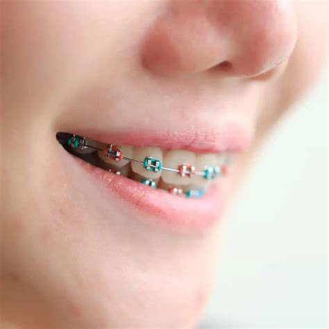 Braces Colors: How to Pick the Best Ones for You